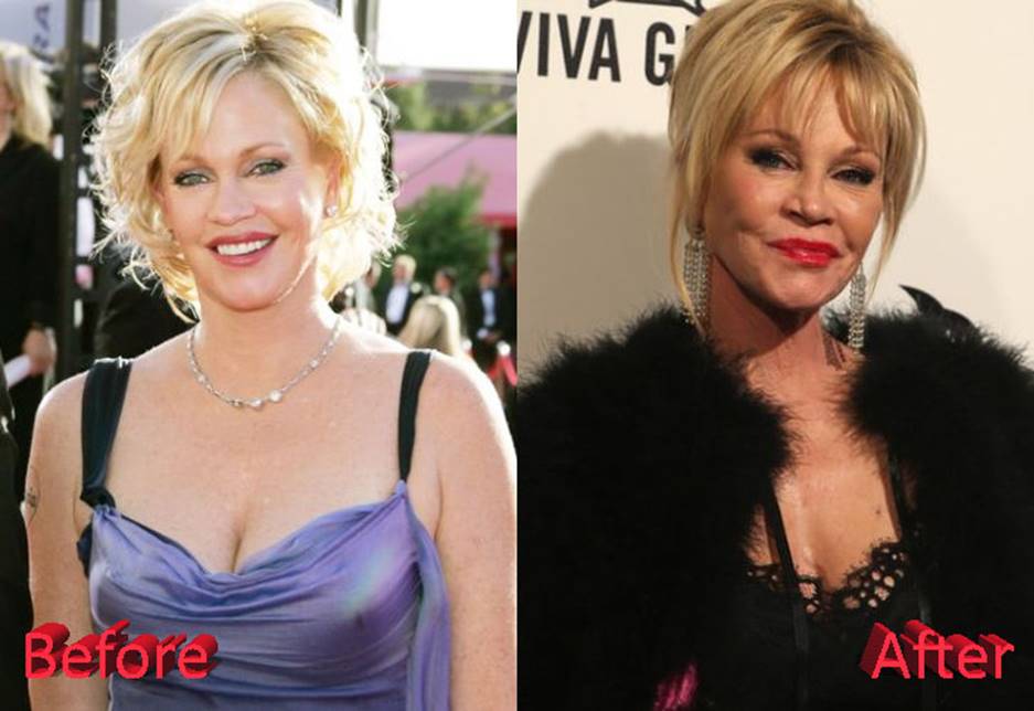 Melanie Griffith Before and After Plastic Surgery Showed